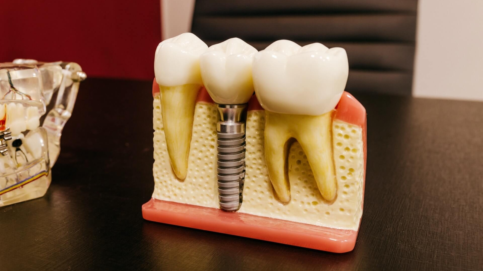 Tratadent Stomatologie implant dentar